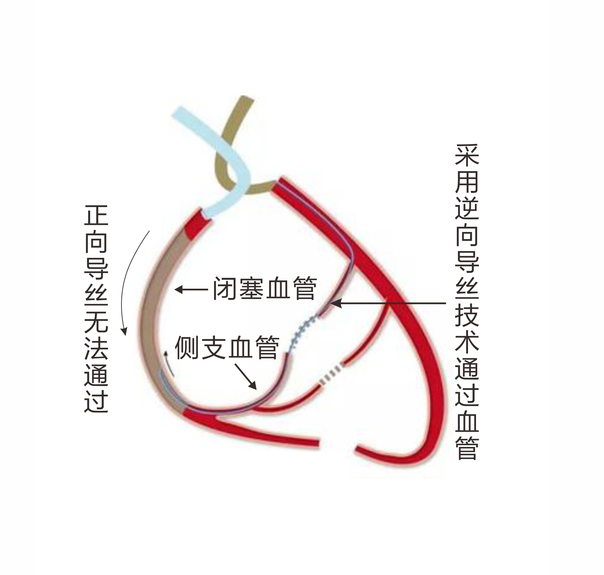 亞心醫(yī)院成功應(yīng)用逆向?qū)Ыz技術(shù)治療冠脈CTO病變(圖1)